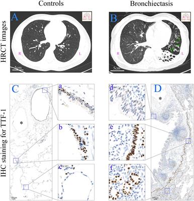 Aberrant Epithelial Cell Proliferation in Peripheral Airways in Bronchiectasis